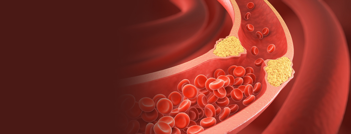 High Cholesterol & Heart Disease: The Silent Threat You Can’t Ignore